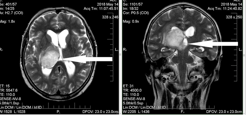 Рак Головного Мозга Фото
