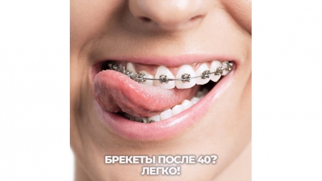 Брекеты после 40? Легко!