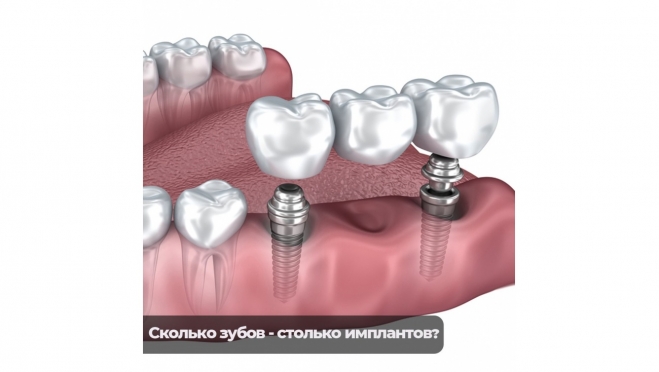 Поступил вопрос от пациента: сколько зубов — столько и ставить имплантов?
