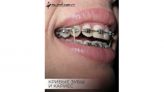 Почему кривые зубы ускоряют развитие кариеса?