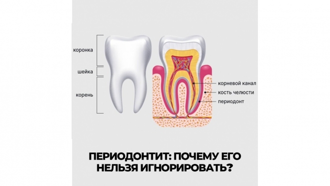 Периодонтит: почему его нельзя игнорировать?