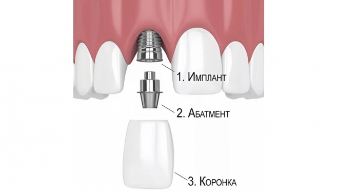 Зубной имплант простыми словами