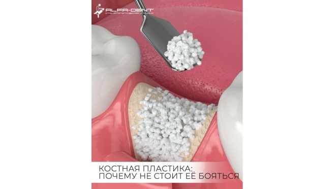 Костная пластика: когда без нее не обойтись и почему ее не стоит бояться?