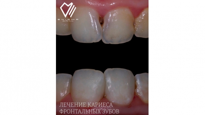 Делимся отличным результатом лечения кариеса фронтальных (передних) зубов в нашей клинике