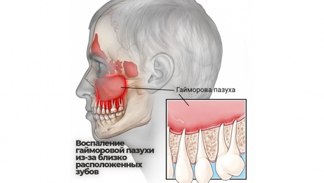 Могут ли проблемы с зубами спровоцировать гайморит ?